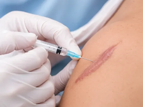 Infiltración de corticoides en una cicatriz queloide del hombro
