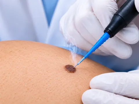Dermatólogo realizando electrocirugía en una lesión cutánea